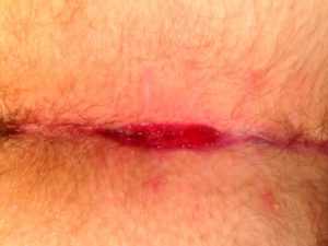 Рис. 4. Рецидив ЭКХ после операции.