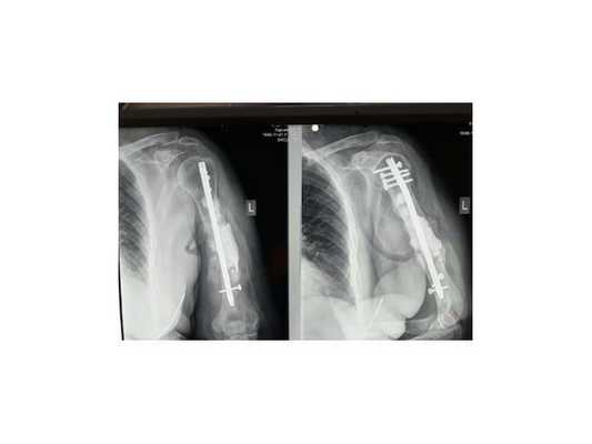 Первый этап пластики дефекта плечевой кости по Маскуле: установка цементной вставки