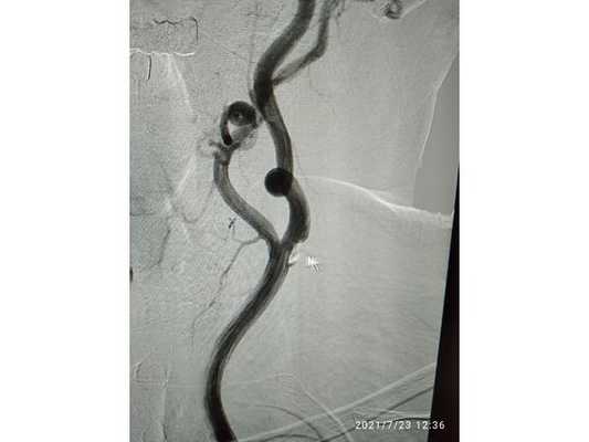 Атеросклеротическая бляшка на фоне патологической извитости сонной артерии