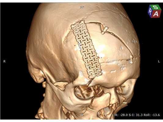 Послеоперационная 3D-реконструкция, верхняя проекция