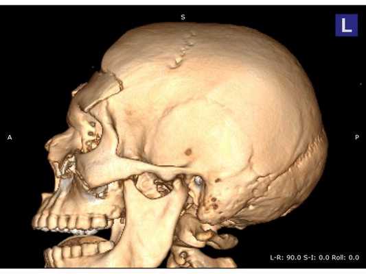 Предоперационная 3D-реконструкция черепа, левая проекция