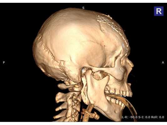 Послеоперационная 3D-реконструкция, правая проекция