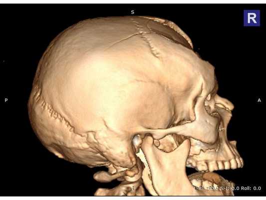 Предоперационная 3D-реконструкция черепа, правая проекция