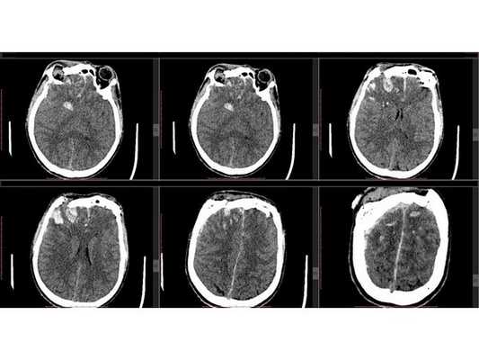 Аксиальные КТ-сканы головного мозга пациента, выполненные при поступлении