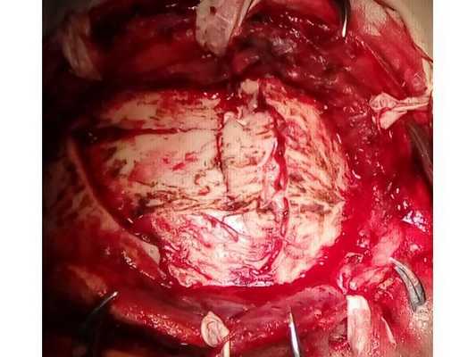 Интраоперационная фотография: видны вдавленные фрагменты лобной кости