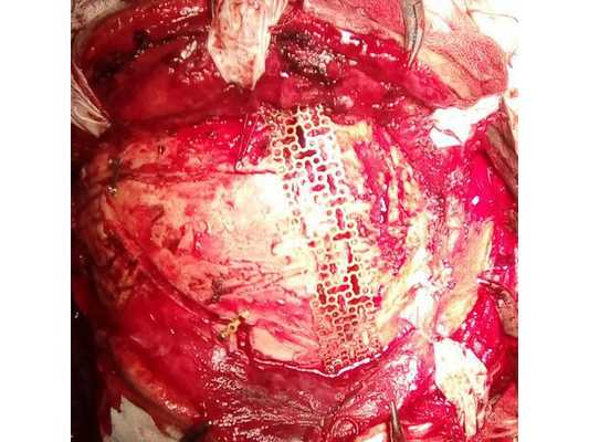 Интраоперационная фотография: костные фрагменты репонированы и фиксированы