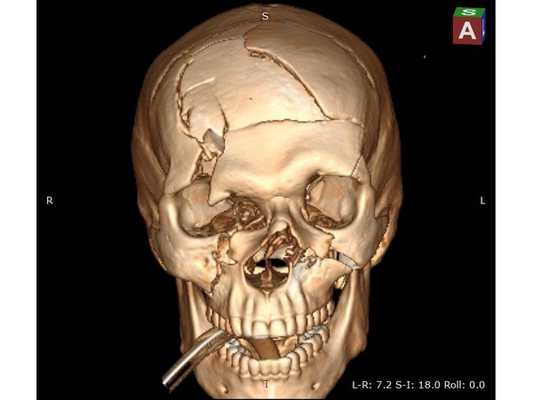 Предоперационная 3D-реконструкция черепа, передняя проекция