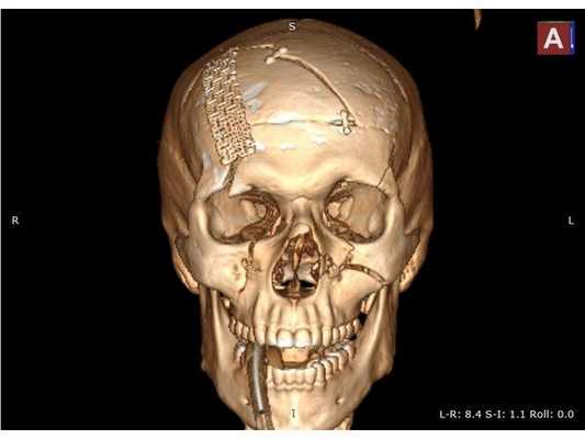 Послеоперационная 3D-реконструкция, передняя проекция