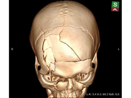 Предоперационная 3D-реконструкция черепа, верхняя проекция