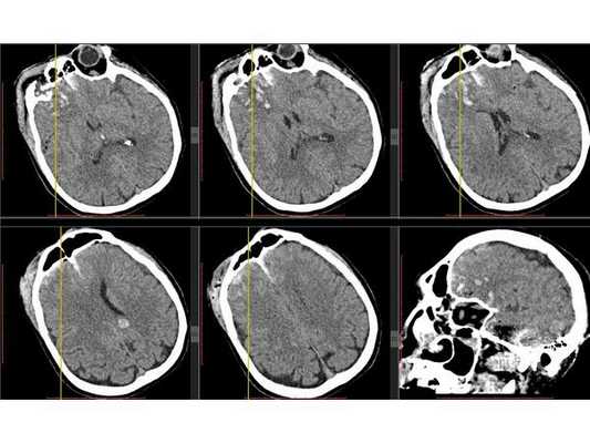 КТ головного мозга в первые сутки после поступления