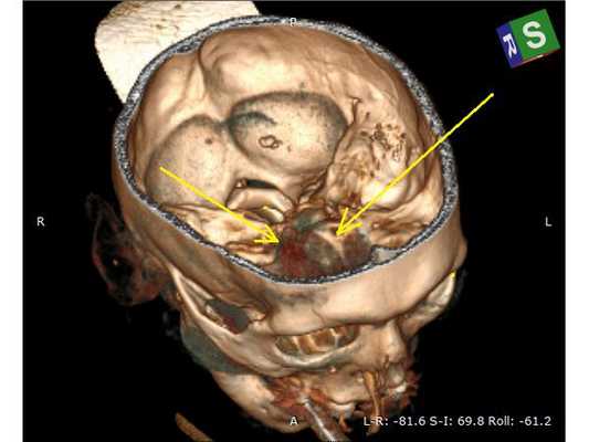 3D-разметка проекции внутримозговой гематомы на свод черепа: вид сверху