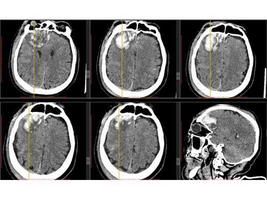 КТ головного мозга на вторые сутки: отсроченное формирование внутримозговой гематомы в правой лобной доле
