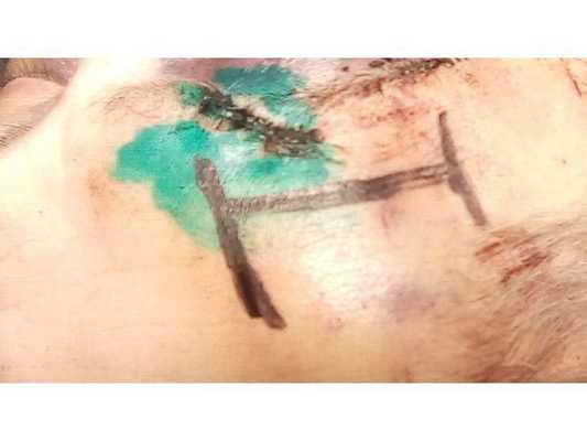 Интраоперационная фотография: разметка доступа на мягких тканях