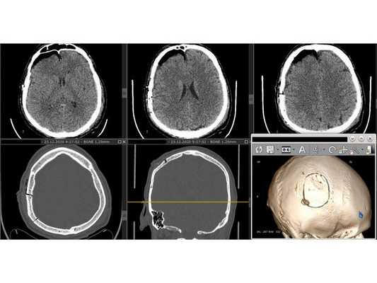 КТ головного мозга после операции