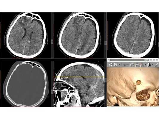 Контрольная КТ головного мозга на третьи сутки стационарного лечения