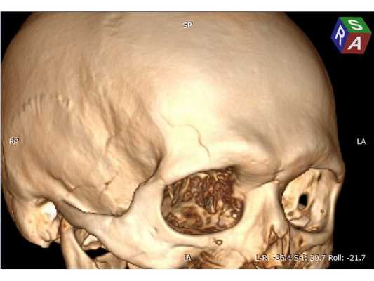 3D-реконструкция на основе КТ-сканов в первые сутки