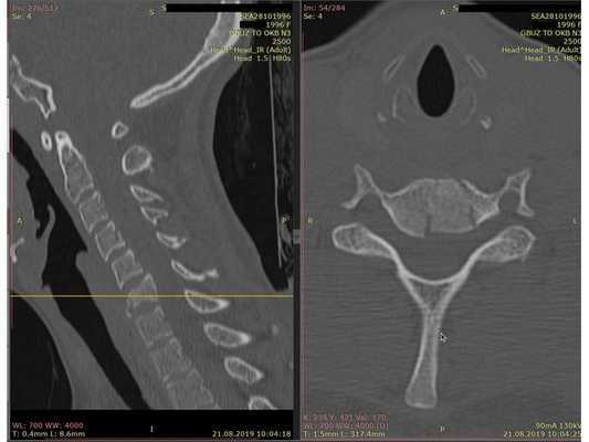 КТ шейного отдела позвоночника. Виден компрессионно-оскольчатый перелом тела позвонка С6.