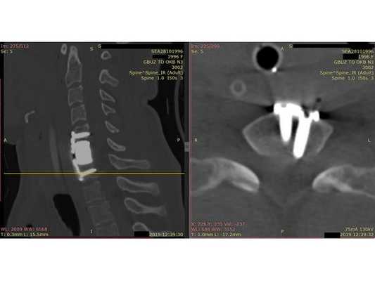 Контрольная КТ шейного отдела позвоночника. Скан на уровне позвонка С7.