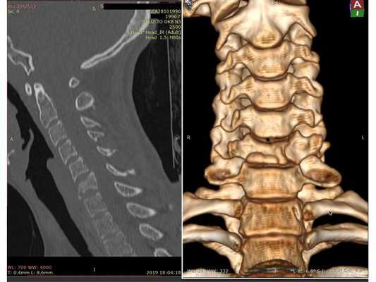 КТ шейного отдела позвоночника. Виден перелом тела позвонка С6.