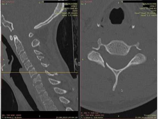 КТ шейного отдела позвоночника. Виден перелом дуги позвонка С6 справа.