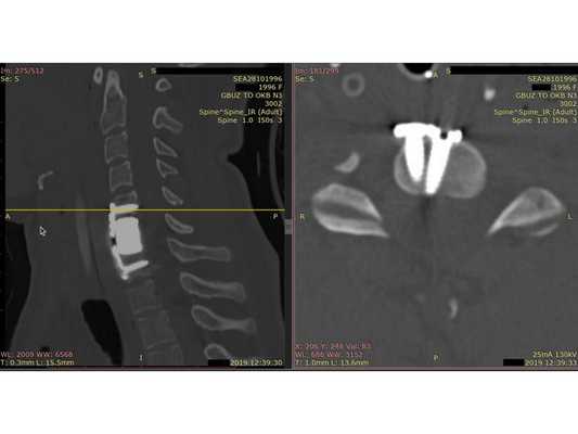 Контрольная КТ шейного отдела позвоночника. Скан на уровне позвонка С5.