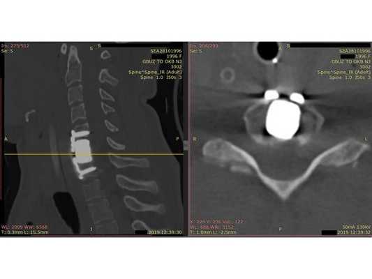 Контрольная КТ шейного отдела позвоночника на уровне тела позвонка С6. Виден установленный кейдж из пористого никелида титана и фиксирующая шейная пластина.