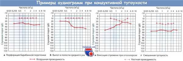 Примеры аудиограмм при кондуктивной тугоухости