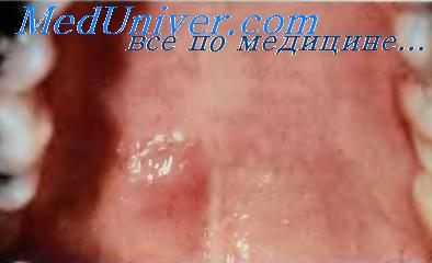 Базально-клеточная (мономорфная) аденома