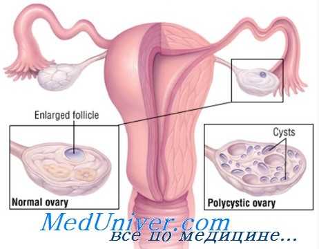 недостаточность яичников