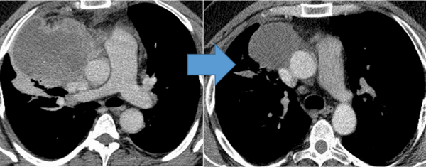 Герминогенная опухоль средостения до лечения и после 4х циклов химиотерапии по схеме «ВЕР » - уменьшение опухоли более чем на 50% (КТ грудной клетки).