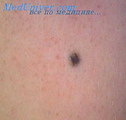 сосудистые мальформации