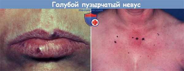голубой пузырчатый невус