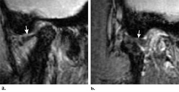 МРТ височно-нижнечелюстных суставов в диагностике заболеваний ВНЧС