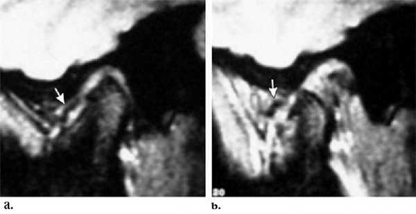 МРТ височно-нижнечелюстных суставов в диагностике заболеваний ВНЧС