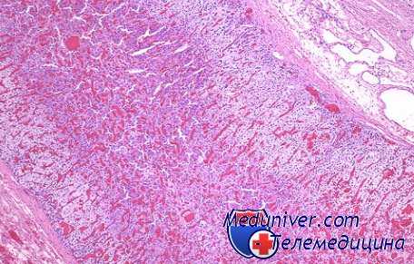 опухоли пищевода