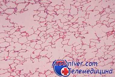 опухоли пищевода