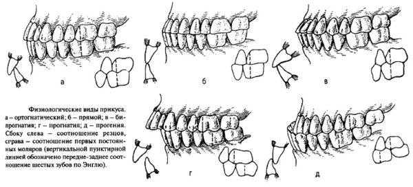 Физиологические виды прикуса