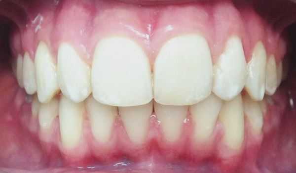 Когда требуется лечение при ортогнатическом прикусе