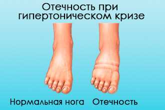 Отечность