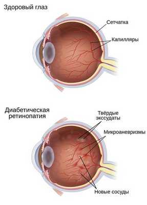 Изменения на сетчатке глаза при диабетической ретинопатии