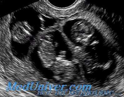 многоплодная беременность