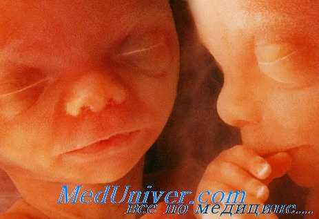 многоплодная беременность при эко