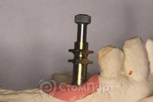 Рис. 3 Положение слепочного колпачка, вкрученного в имплантат