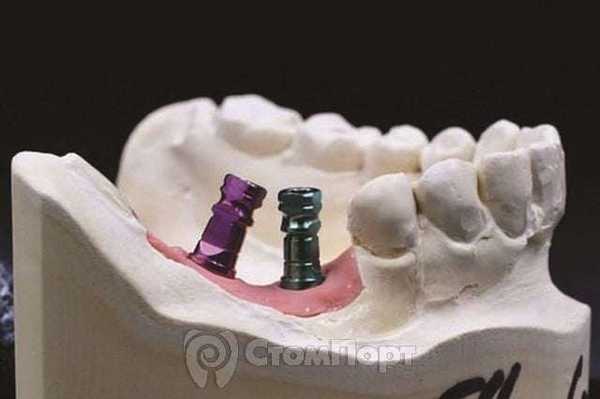 Сравнение методов открытой и закрытой ложки