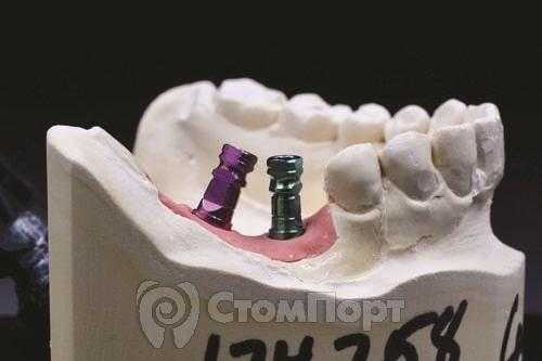 Рис. 1 Снятие слепка для нескольких имплантатов