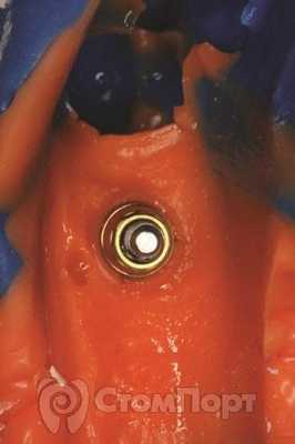 Рис. 4 Оттиск снятый с помощью техники открытой ложки