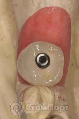 Рис. 6. Примерка готовой коронки