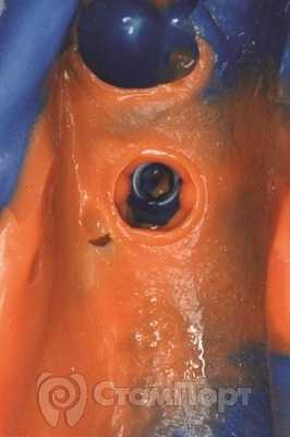 Рис. 2 Отпечаток слепочного колпачка в готовом оттиске