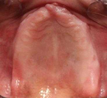 Одноэтапная техника снятия оттиска с болтающегося гребня монофазным поливинилсилоксановым материалом