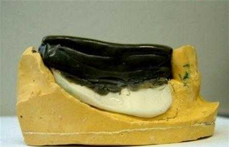 Упрощенная техника получения оттисков для частичных съемных протезов в условиях дистального удлинения